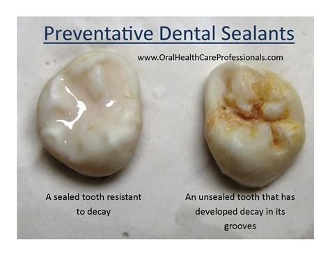 Preventative Dental Sealants Are A Fantastic Way To Prevent Cavities Sealants Protect The Tooth