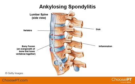 guide physical therapy guide to ankylosing spondylitis choose pt