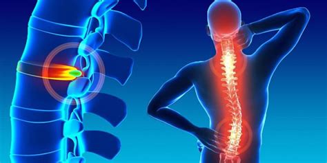 Hernias De Disco Causas Síntomas Y Tratamiento Vida Con Salud