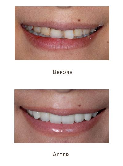 In this system, the old teeth are covered up. Cosmetic Dentistry What is it | Improve teeth appearance