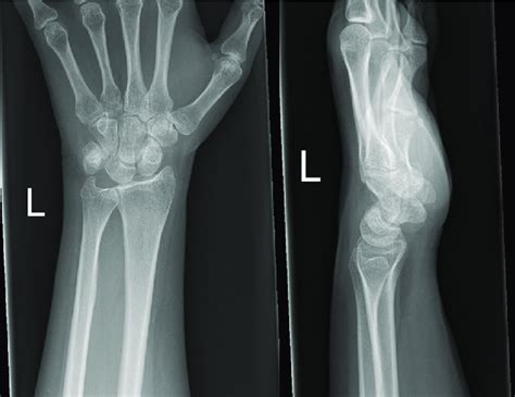 Pre Operative Ap And Lateral Radiographs On The Lateral Radiograph