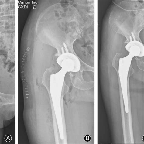 A The Preoperative Anteroposterior View Of The Right Hip Joint Of A