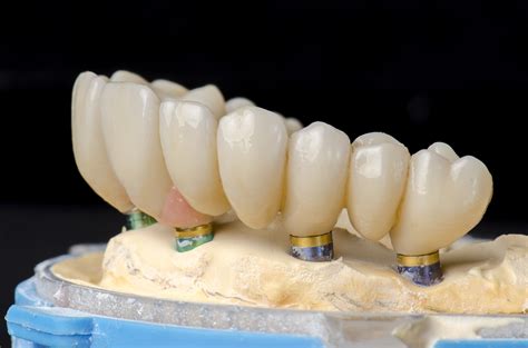Implant Supported Full Arch Restorations All On 4 Teeth Tomorrow And
