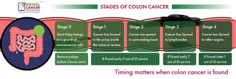 Stages Of Bowel Cancer Bowel Cancer Foundation Of India