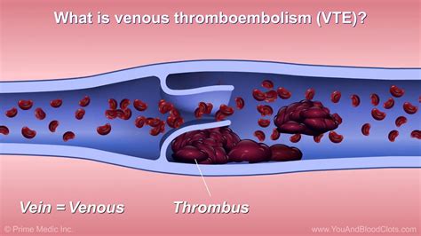 Understanding And Diagnosing Venous Thromboembolism Vte3 Youtube