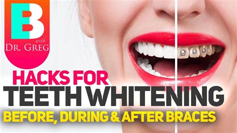 Braces Hacks To Keep Your Teeth White Teeth Whitening With Braces And