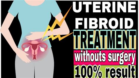 Uterine Fibroid Causes And Treatment With Out Surgery Youtube