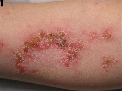 A Closer Look At Skin And Soft Tissue Infections