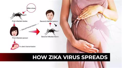 Explained How Zika Virus Spreads And What You Can Do To Stay Safe In Depth Times Of India