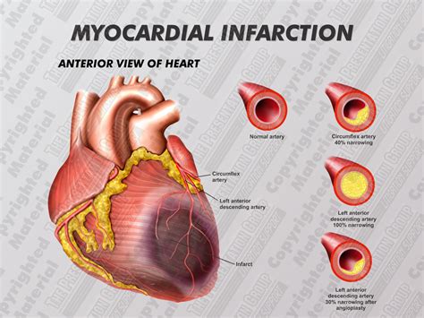 Myocardial Infarct Pictures