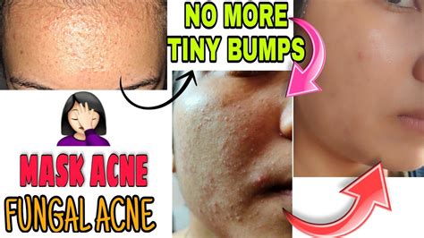 Get Rid Of Tiny Bumps On Face Home Remedies In 1weekmask Acne Removal