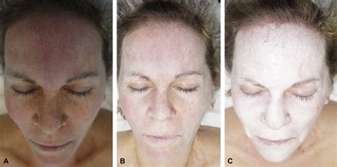 Supplemental Materials For Basic Chemical Peeling Superficial And