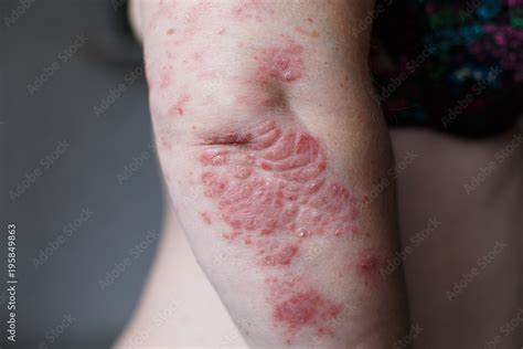 Psoriasis Skin Psoriasis Is An Autoimmune Disease That Affects The