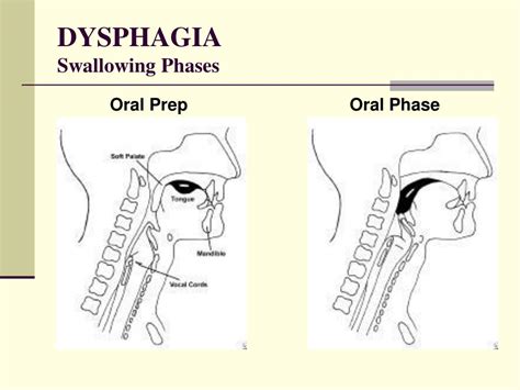 Ppt Comprehensive Dysphagia Management Powerpoint Presentation Free