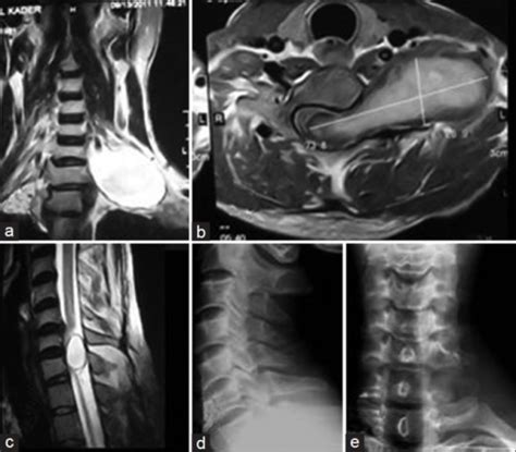 Preoperative Mri Of Cervical Spine A Coronal View B A Open I