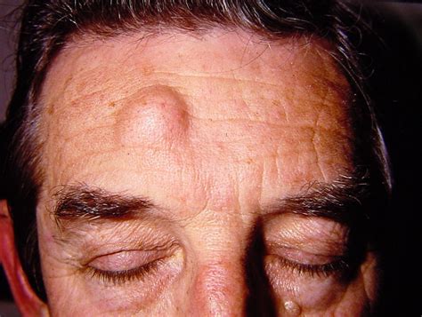Dermoid Cyst Forehead