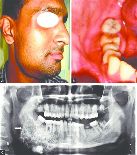 A An Extra‑oral Photograph Of The Patient Having Swelling On Right