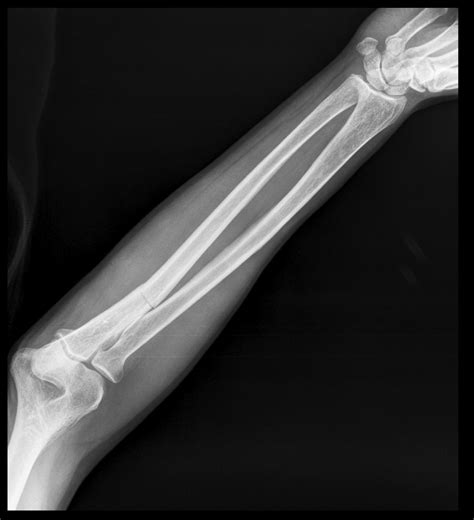Ulnar Bone Fracture Classification Wikidoc