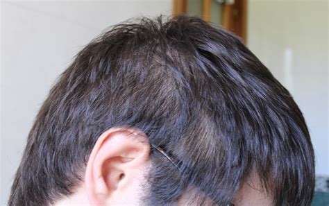 I immmediately noticed thinning of my hair, but the doctor said it's normal and will return after discontinuing treatment. Long term DIFFUSE hair loss after Accutane and sebum ...