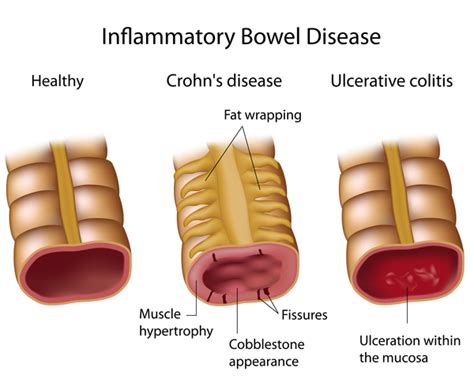 Ibd Inflammatory Bowel Disease Facts Chronic Kidney Disease