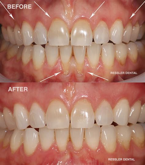 Receding Gums Before And After