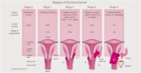 Cervical Cancer Treatments