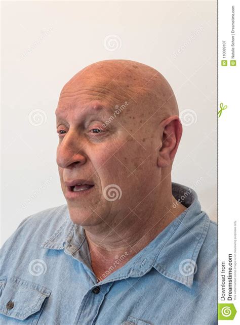 Confused Older Man Who Is Bald Has Alopecia Chemotherapy Cancer On