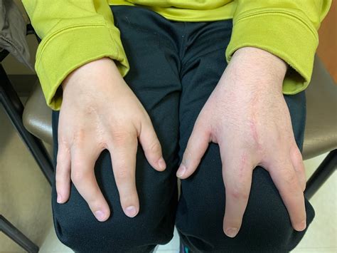 Cleft Hand Beyond The Basics Congenital Hand And Arm Differences