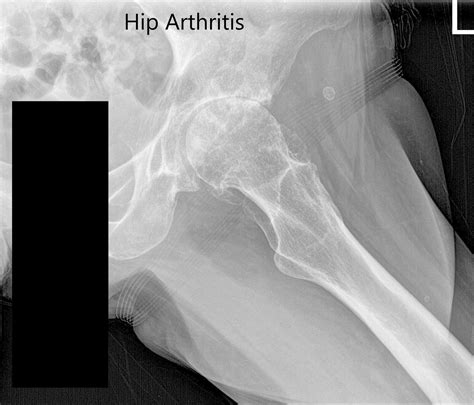 Case Study Bilateral Total Hip Arthritis In 66 Yr Old Male