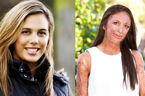 MICHAEL HOSKIN AND TURIA PITT STORY PROVES TRUE LOVE NEVER ENDS