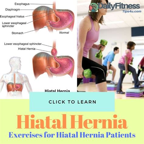 Top And Best Exercises For Hiatal Hernia Patients
