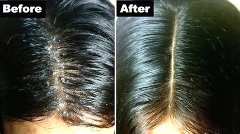 I looked at girls around me, they all looked normal with the perfect face rather hairless face. Remove Dandruff Permanently in just One Day || Hair Fall ...