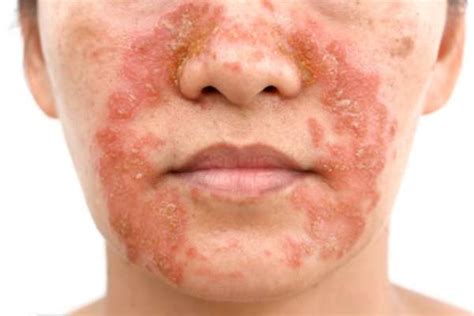 Eczema On Face Best Doctor For Homeopathy Treatment To Cure