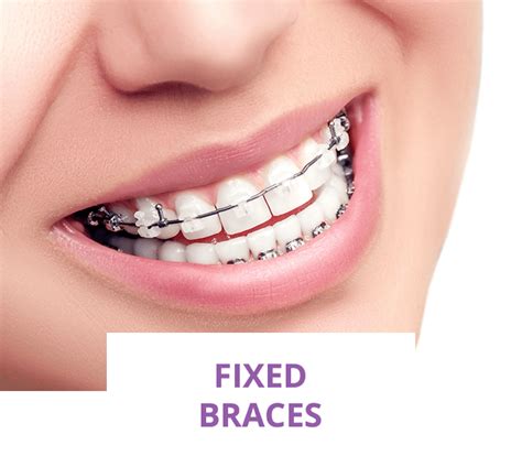 Can teeth gaps be closed without braces. Braces Radbourne Derbyshire | Invisalign Invisible Braces, Damon, Incognito lingual braces, Six ...