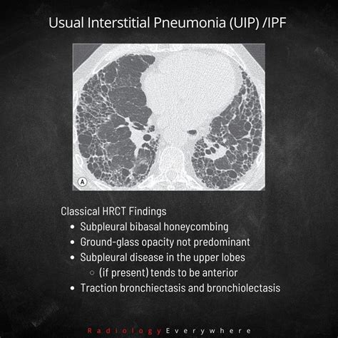 Usual Interstitial Pneumonia Uip Rradiology