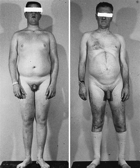 Fat Turner Syndrome