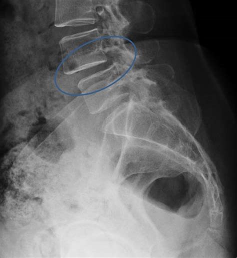 Occasionally, disc herniation is incidentally detected when a test such as an mri is performed for other reasons. Severe Lumbar Spinal Stenosis with Spondylolisthesis