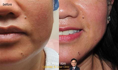 Cosmetic Injection Sydney Dr Peter Kim Surgery Skin Cancer