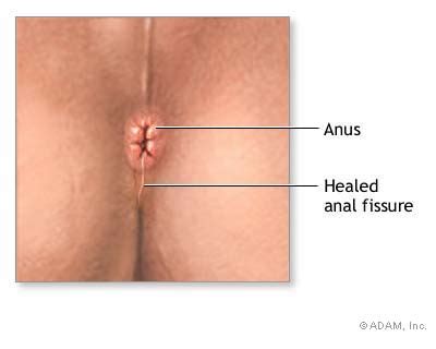 The New York Times Health Slide Show Anal Fissure Slide Of