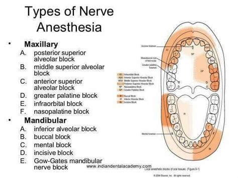 Types Of Nerve Anesthesia Dental Assistant Study Dental Hygiene