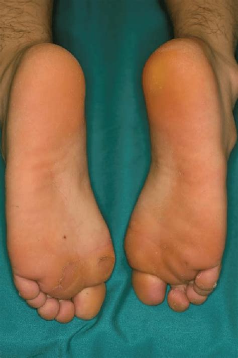 Clinical Picture Of Hyperkeratosis On The Right Heel And Slightly Download Scientific Diagram