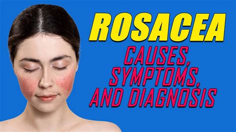 Rosacea Causes Symptoms And Diagnosis Health Fit Youtube