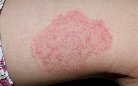 A Guide To Treating Skin Infections Bacterial Viral Fungal And Paras