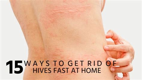 15 Ways To Get Rid Of Hives Fast At Home Allergy Hives Hives