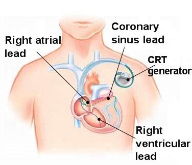 An icd also has a back up pacemaker but can deliver a shock to the heart when it is. Cardiac Resynchronization Therapy (CRT), Washington DC ...