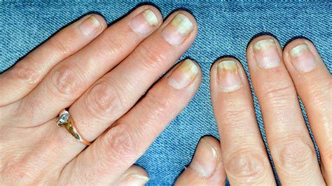 Top 117 What Is The Reason For Nail Damage Architectures Eric