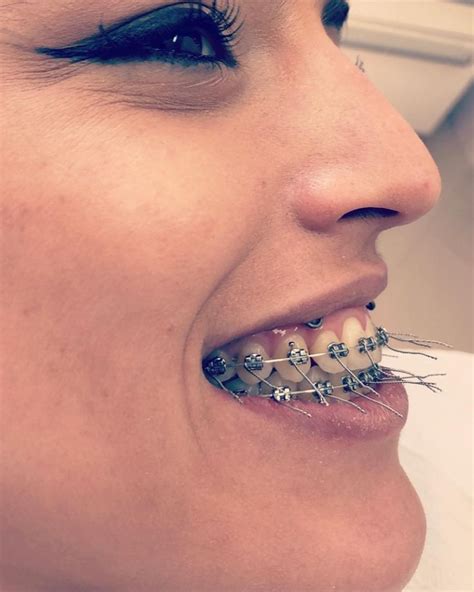 Braces Girlswithbraces Metalbraces Dental Braces Teeth Braces Braces Colors
