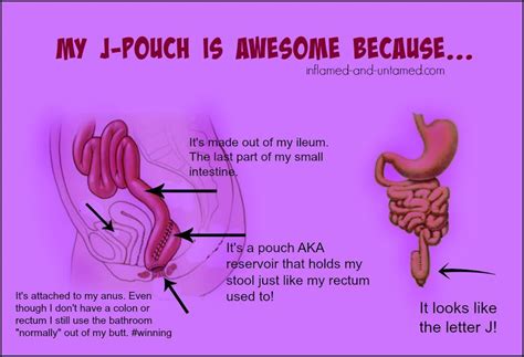 Check spelling or type a new query. Pin on (F.A.P.)...Colon Cancer