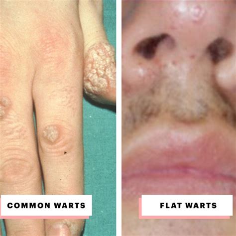 Every Type Of Wart And How To Treat It Visual Guide Allure