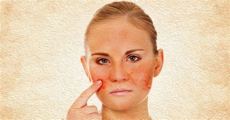 13 Home Remedies To Fight Rosacea Or Adult Acne